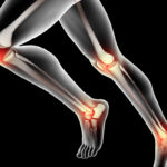 douleurs au genou nice-osteopathe nice-osteopathie saint laurent du var-osteopathe pour sportifs alpes maritimes-cabinet d osteopathie nice